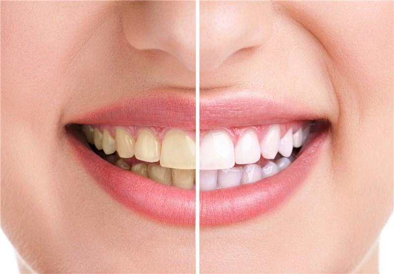 پوشش نانوذره ای مانع پوسیدگی دندان ها می شود