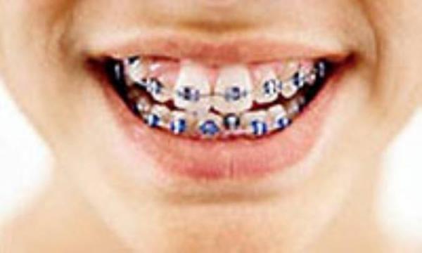 کی برویم ارتودنسی؟ کی برویم ارتودنسی؟